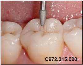 Dijamantna svrdla, granata okrugli 972 - Edenta - Slika 3